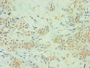 SPINT1 / HAI-1 Antibody - Immunohistochemistry of paraffin-embedded human breast cancer using SPINT1 Antibody at dilution of 1:100
