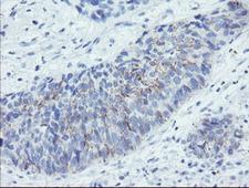 SPINT1 / HAI-1 Antibody - IHC of paraffin-embedded Carcinoma of Human lung tissue using anti-SPINT1 mouse monoclonal antibody. (Heat-induced epitope retrieval by 10mM citric buffer, pH6.0, 100C for 10min).