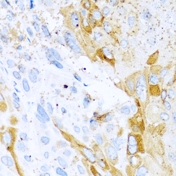 SPINT1 / HAI-1 Antibody - Immunohistochemistry of paraffin-embedded mouse esophageal cancer tissue.