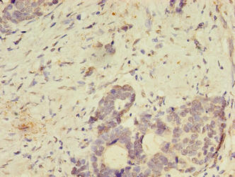 SPIRE2 Antibody - Immunohistochemistry of paraffin-embedded human gastric cancer using SPIRE2 Antibody at dilution of 1:100