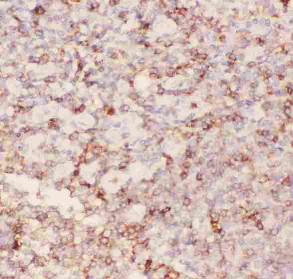 SPN / CD43 Antibody - IHC analysis of CD43 using anti-CD43 antibody. CD43 was detected in paraffin-embedded section of human tonsil tissues. Heat mediated antigen retrieval was performed in citrate buffer (pH6, epitope retrieval solution) for 20 mins. The tissue section was blocked with 10% goat serum. The tissue section was then incubated with 1µg/ml rabbit anti-CD43 Antibody overnight at 4°C. Biotinylated goat anti-rabbit IgG was used as secondary antibody and incubated for 30 minutes at 37°C. The tissue section was developed using Strepavidin-Biotin-Complex (SABC) with DAB as the chromogen.