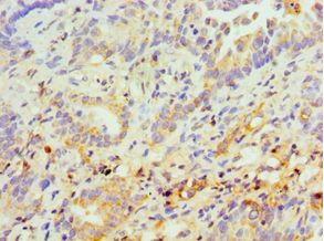 SPN / CD43 Antibody - Immunohistochemistry of paraffin-embedded human lung cancer using antibody at 1:100 dilution.