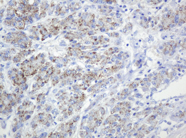 SPN / CD43 Antibody - IHC of paraffin-embedded Carcinoma of Human liver tissue using anti-SPN mouse monoclonal antibody. (Heat-induced epitope retrieval by 10mM citric buffer, pH6.0, 120°C for 3min).