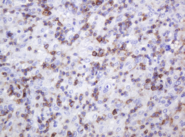 SPN / CD43 Antibody - IHC of paraffin-embedded Human lymphoma tissue using anti-SPN mouse monoclonal antibody.