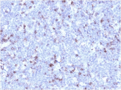 SPN / CD43 Antibody - Formalin-fixed, paraffin-embedded human Lymphomastained with CD43 Mouse Recombinant Monoclonal Antibody (rSPN/1094).