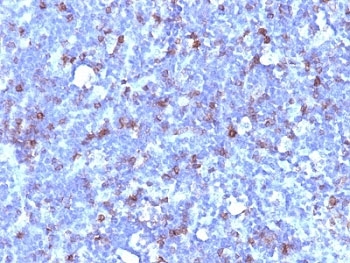 SPN / CD43 Antibody - Formalin-fixed, paraffin-embedded human lymphoma stained with CD43 antibody (SPN/1094).  This image was taken for the unmodified form of this product. Other forms have not been tested.