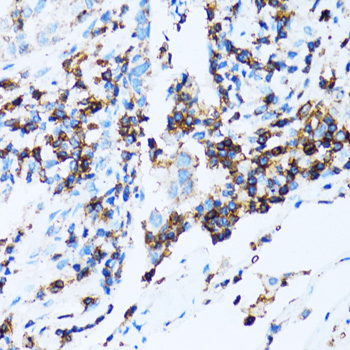 SPN / CD43 Antibody - Immunohistochemistry of paraffin-embedded human lung cancer tissue.
