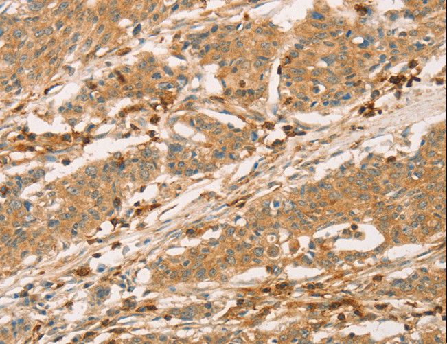 SPN / CD43 Antibody - Immunohistochemistry of paraffin-embedded Human gastric cancer using SPN Polyclonal Antibody at dilution of 1:60.