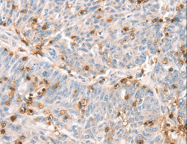 SPN / CD43 Antibody - Immunohistochemistry of paraffin-embedded Human ovarian cancer using SPN Polyclonal Antibody at dilution of 1:30.