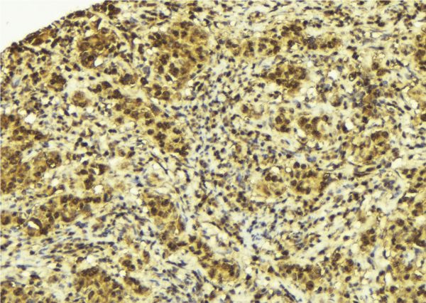 SPOP Antibody - 1:100 staining human breast carcinoma tissue by IHC-P. The sample was formaldehyde fixed and a heat mediated antigen retrieval step in citrate buffer was performed. The sample was then blocked and incubated with the antibody for 1.5 hours at 22°C. An HRP conjugated goat anti-rabbit antibody was used as the secondary.