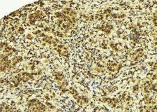 SPOP Antibody - 1:100 staining human breast carcinoma tissue by IHC-P. The sample was formaldehyde fixed and a heat mediated antigen retrieval step in citrate buffer was performed. The sample was then blocked and incubated with the antibody for 1.5 hours at 22°C. An HRP conjugated goat anti-rabbit antibody was used as the secondary.
