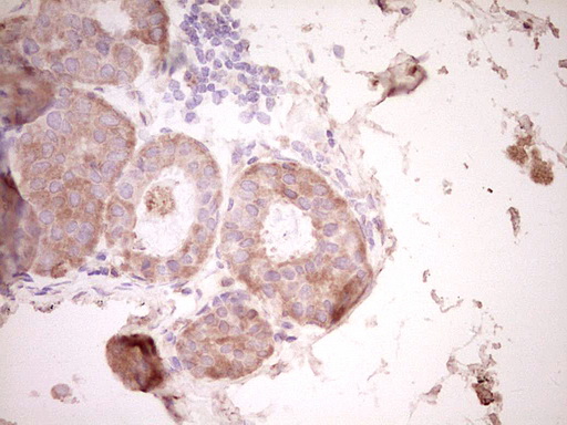 SPP1 / Osteopontin Antibody - IHC of paraffin-embedded Adenocarcinoma of Human breast tissue using anti-SPP1 mouse monoclonal antibody. (Heat-induced epitope retrieval by 1 mM EDTA in 10mM Tris, pH8.5, 120°C for 3min).