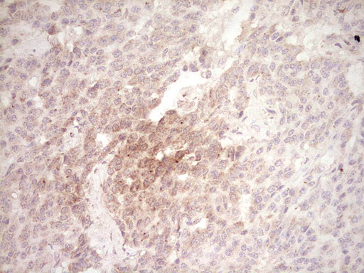 SPP1 / Osteopontin Antibody - IHC of paraffin-embedded Carcinoma of Human lung tissue using anti-SPP1 mouse monoclonal antibody. (Heat-induced epitope retrieval by 1 mM EDTA in 10mM Tris, pH8.5, 120°C for 3min).