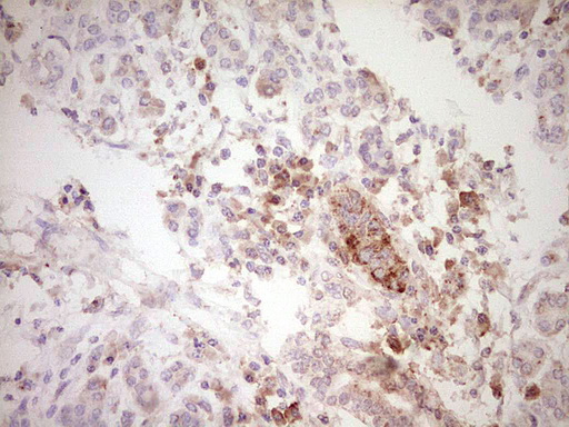 SPP1 / Osteopontin Antibody - IHC of paraffin-embedded Carcinoma of Human pancreas tissue using anti-SPP1 mouse monoclonal antibody. (Heat-induced epitope retrieval by 1 mM EDTA in 10mM Tris, pH8.5, 120°C for 3min).
