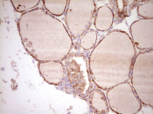 SPP1 / Osteopontin Antibody - IHC of paraffin-embedded Human thyroid tissue using anti-SPP1 mouse monoclonal antibody. (Heat-induced epitope retrieval by 1 mM EDTA in 10mM Tris, pH8.5, 120°C for 3min).