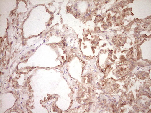 SPP1 / Osteopontin Antibody - IHC of paraffin-embedded Carcinoma of Human prostate tissue using anti-SPP1 mouse monoclonal antibody. (Heat-induced epitope retrieval by 1 mM EDTA in 10mM Tris, pH8.5, 120°C for 3min).