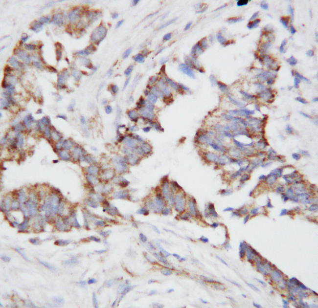 SPP1 / Osteopontin Antibody - SPP1 / Osteopontin antibody. IHC(P): Human Breast Cancer Tissue.