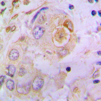 SPP1 / Osteopontin Antibody - Immunohistochemical analysis of Osteopontin staining in human lung cancer formalin fixed paraffin embedded tissue section. The section was pre-treated using heat mediated antigen retrieval with sodium citrate buffer (pH 6.0). The section was then incubated with the antibody at room temperature and detected using an HRP conjugated compact polymer system. DAB was used as the chromogen. The section was then counterstained with hematoxylin and mounted with DPX.
