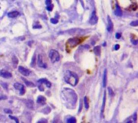 SPP1 / Osteopontin Antibody - Osteopontin Antibody (1B20) - IHC of Osteopontin on human lung adenocarcinoma.  This image was taken for the unconjugated form of this product. Other forms have not been tested.