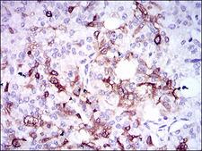 SPP1 / Osteopontin Antibody - IHC of paraffin-embedded prostate cancer tissues using SPP1 mouse monoclonal antibody with DAB staining.