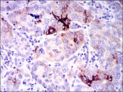 SPP1 / Osteopontin Antibody - IHC of paraffin-embedded endometrial cancer tissues using SPP1 mouse monoclonal antibody with DAB staining.
