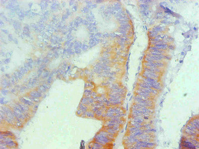SPP1 / Osteopontin Antibody - Immunohistochemical of paraffin-embedded human colon cancer using SPP1 Monoclonal Antibody at dilution of 1:200
