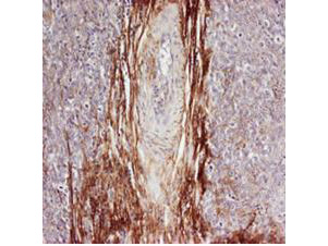 SPP1 / Osteopontin Antibody - Rabbit anti-Osteopontin was used at a 1:100-1:300 dilution to detect osteopontin by immunohistochemistry. Osteopontin is a normal component of elastic fibers in the breast (shown heavily stained in this section of human breast tumor cells). There is also weak staining of the extracellular matrix. Osteopontin is not expressed in breast tumor cells, and there is no staining of the breast cells in this section. No antigen retrieval is required.