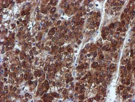 SPR Antibody - IHC of paraffin-embedded Carcinoma of Human liver tissue using anti-SPR mouse monoclonal antibody.