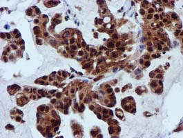 SPR Antibody - IHC of paraffin-embedded Carcinoma of Human lung tissue using anti-SPR mouse monoclonal antibody.