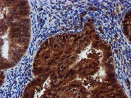 SPR Antibody - IHC of paraffin-embedded Adenocarcinoma of Human endometrium tissue using anti-SPR mouse monoclonal antibody.