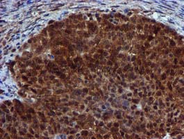 SPR Antibody - IHC of paraffin-embedded Adenocarcinoma of Human ovary tissue using anti-SPR mouse monoclonal antibody.