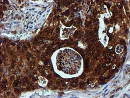 SPR Antibody - IHC of paraffin-embedded Carcinoma of Human pancreas tissue using anti-SPR mouse monoclonal antibody.