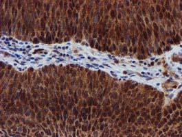 SPR Antibody - IHC of paraffin-embedded Carcinoma of Human bladder tissue using anti-SPR mouse monoclonal antibody.