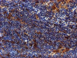 SPR Antibody - IHC of paraffin-embedded Human lymphoma tissue using anti-SPR mouse monoclonal antibody.