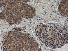 SPR Antibody - IHC of paraffin-embedded Adenocarcinoma of Human breast tissue using anti-SPR mouse monoclonal antibody.