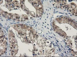 SPR Antibody - IHC of paraffin-embedded Adenocarcinoma of Human ovary tissue using anti-SPR mouse monoclonal antibody.