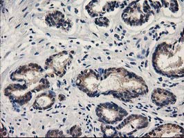 SPR Antibody - IHC of paraffin-embedded Carcinoma of Human prostate tissue using anti-SPR mouse monoclonal antibody.