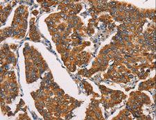 SPR Antibody - Immunohistochemistry of paraffin-embedded Human breast cancer using SPR Polyclonal Antibody at dilution of 1:40.