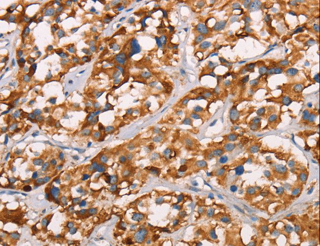 SPR Antibody - Immunohistochemistry of paraffin-embedded Human thyroid cancer using SPR Polyclonal Antibody at dilution of 1:40.