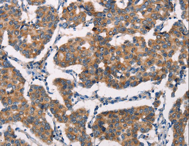 SPR Antibody - Immunohistochemistry of paraffin-embedded Human breast cancer using SPR Polyclonal Antibody at dilution of 1:20.