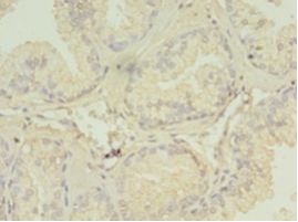 SPRING / TRIM9 Antibody - Immunohistochemistry of paraffin-embedded human prostate cancer using antibody at 1:100 dilution.  This image was taken for the unconjugated form of this product. Other forms have not been tested.