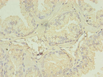 SPRING / TRIM9 Antibody - Immunohistochemistry of paraffin-embedded human prostate cancer using TRIM9 Antibody at dilution of 1:100