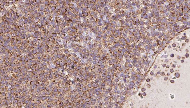 SPRING / TRIM9 Antibody - 1:100 staining human lymph carcinoma tissue by IHC-P. The sample was formaldehyde fixed and a heat mediated antigen retrieval step in citrate buffer was performed. The sample was then blocked and incubated with the antibody for 1.5 hours at 22°C. An HRP conjugated goat anti-rabbit antibody was used as the secondary.
