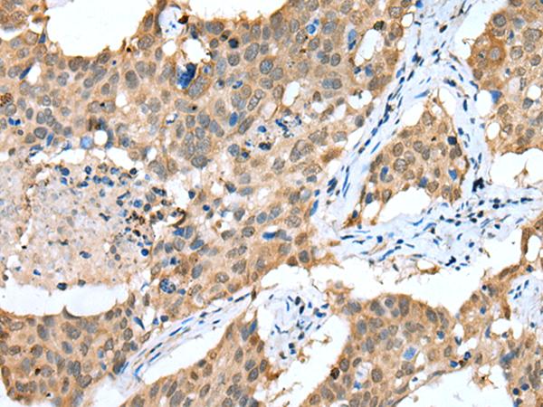 Sprouty 4 / SPRY4 Antibody - Immunohistochemistry of paraffin-embedded Human lung cancer tissue  using SPRY4 Polyclonal Antibody at dilution of 1:25(×200)