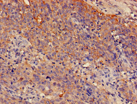 SPRR1A Antibody - Immunohistochemistry of paraffin-embedded human cervical cancer using SPRR1A Antibody at dilution of 1:100