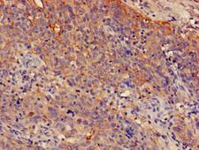 SPRR1A Antibody - Immunohistochemistry of paraffin-embedded human cervical cancer using SPRR1A Antibody at dilution of 1:100