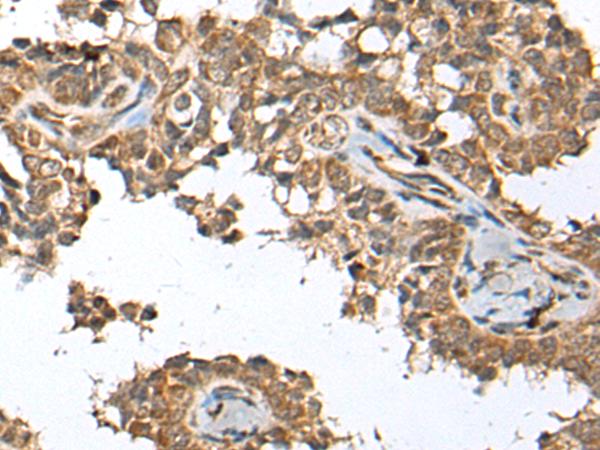 SPRTN / C1orf124 Antibody - Immunohistochemistry of paraffin-embedded Human ovarian cancer tissue  using SPRTN Polyclonal Antibody at dilution of 1:65(×200)