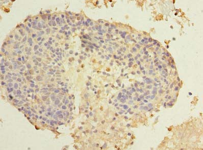 SPRYD5 Antibody - Immunohistochemistry of paraffin-embedded human cervical cancer using antibody at dilution of 1:100.