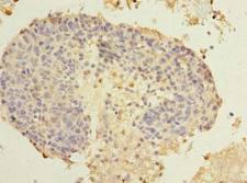 SPRYD5 Antibody - Immunohistochemistry of paraffin-embedded human cervical cancer using antibody at dilution of 1:100.