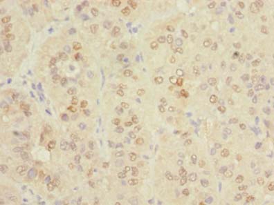 SPRYD5 Antibody - Immunohistochemistry of paraffin-embedded human liver cancer using antibody at dilution of 1:100.